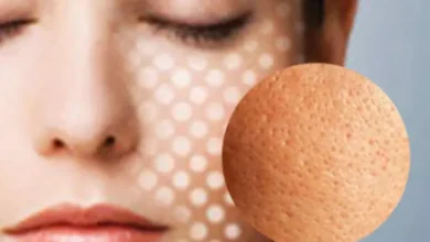 بهترین روش درمان منافذ باز پوست